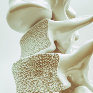 silicio e osteoporosi
